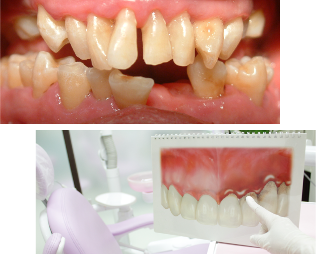歯周病の写真