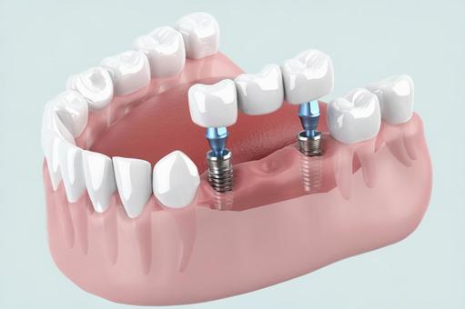 インプラントを飲み込んでしまった！｜焦らず対処するための行うべき対処法を解説