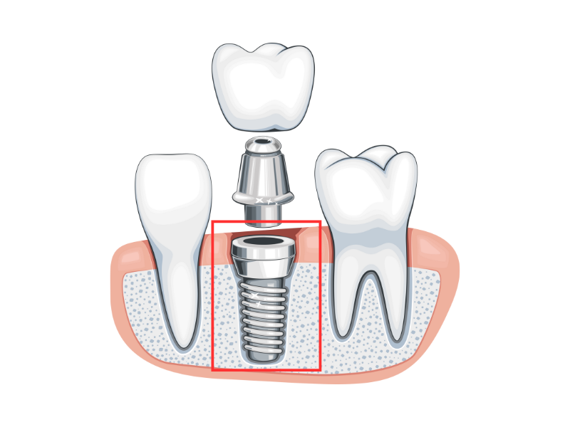 インプラント体（人工歯根）