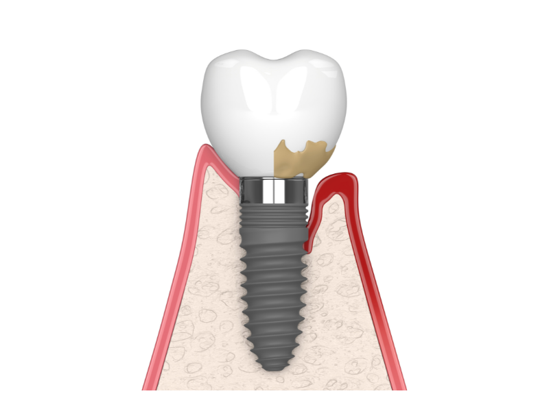 インプラント周囲炎