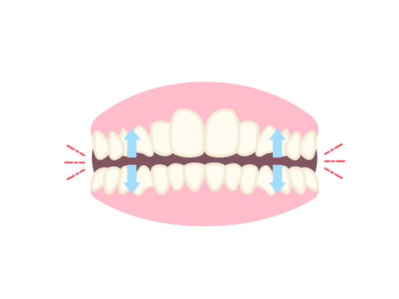 上部構造（被せ物）