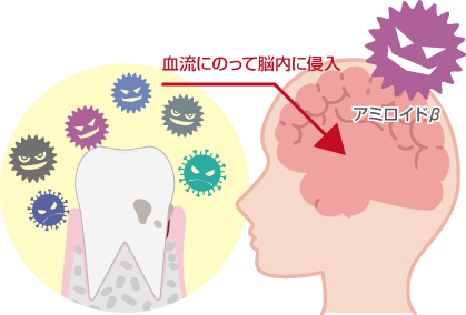 歯周病がアルツハイマー型認証の原因となる理由図解