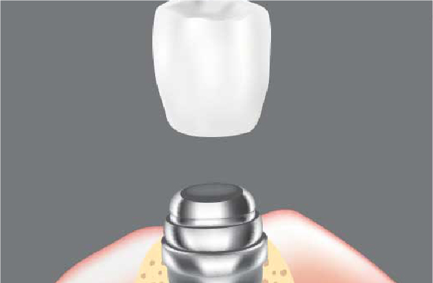 人工歯（上部構造）の装着