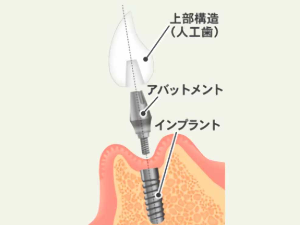 インプラントの構造