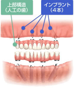 人工的に歯肉を再現することで強度を高めたオールオン4