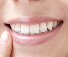 前歯と他の歯のインプラントの違いって？