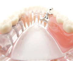 インプラントと入れ歯の大きな違い