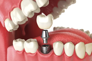 インプラント治療と差し歯治療の治療方法の違い