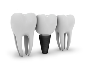 増田歯科の安心できるインプラントシステムとは？