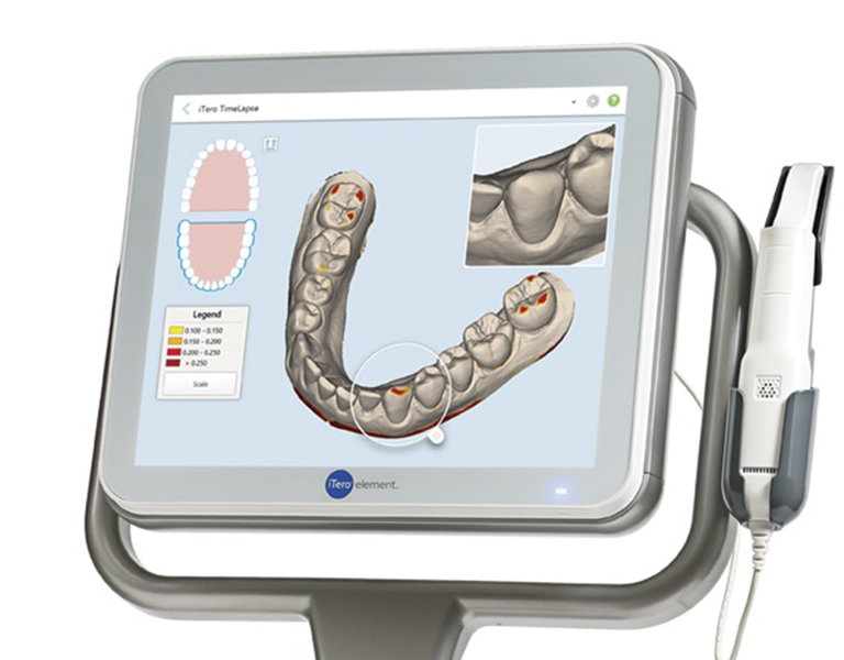 口腔内スキャナ　iTeroの画面